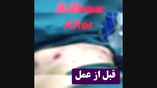 جراحی ژنیکوماستی (کوچک کردن سینه آقایان)