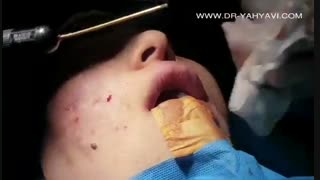 تزریق چربی به صورت | دکتر شهریار یحیوی