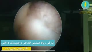 پارگی رباط صلیبی