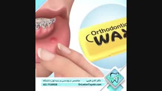 موم ارتودنسی | دکتر لادن طیبی