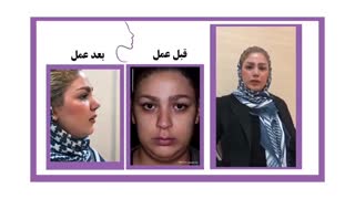 فیلم جراحی بینی گوشتی