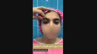 جراحی لیفت اندوسکوپیک ابرو با اندوتاین