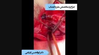 تشنج مقاوم به درمان