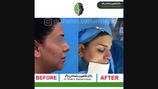 ویدئوی جراحی بینی ترمیمی