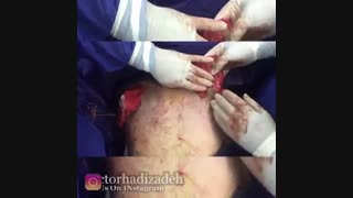 فیلم عمل کوچک کردن سینه مردان