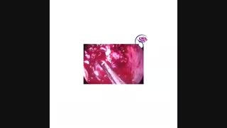 انکسارات عظام المخ