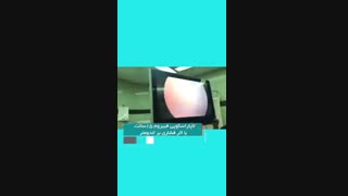 لاپاراسکوپی فیبروم