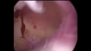 کولپوسکوپی و بیوپسی تحولی شگرف در تشخیص به موقع سرطان دهانه رحم