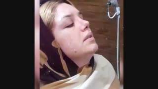 برداشتن گچ بینی