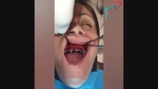 ایمپلنت فول فک بالا