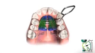 دستگاه پندلوم | کلینیک دندانپزشکی ایده آل