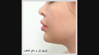 رفع غبغب