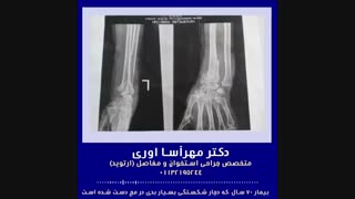 عمل جراحی شکستگی مچ دست