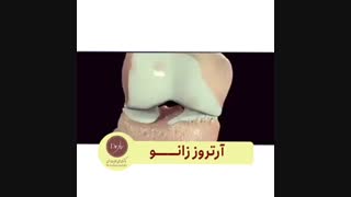 آرتروز زانو چگونه اتفاق می افتد ؟