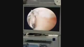 آرتروسکوپی مچ پا