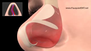 انحراف بینی چیست ؟ روش های درمانی