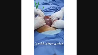 فیلم جراحی سرطان تخمدان