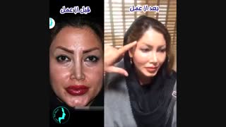 تزریق چربی و جوانسازی صورت | دکتر گلی