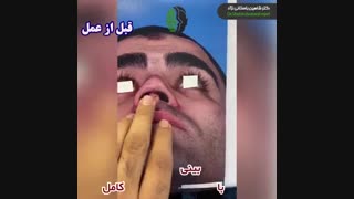 فیلم عمل بینی ترمیمی