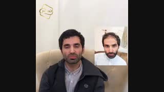 کاشت مو به روشSUT -کلینیک تخصصی رنسانس لیفت پیشانی