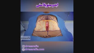 انیمیشن جراحی زیبایی شکم | دکتر رفیع