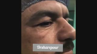بلفاروپلاستى در آقایان