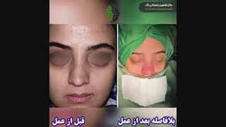 نتیجه جراحی زیبایی بینی گوشتی