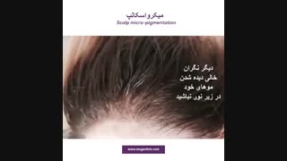 درمان شوره سر