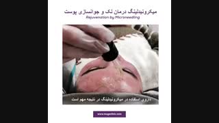 میکرونیدلینگ درمان لک لیزر صورت