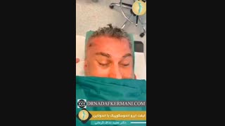 جراحی لیفت اندوسکوپیک ابرو با اندوتاین