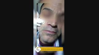 تزریق فیلر خط خنده