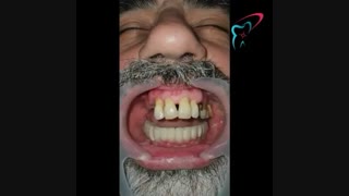 ایمپلنت فول فک پایین