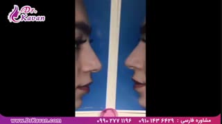 عمل زیبایی بینی و رفع انحراف آن