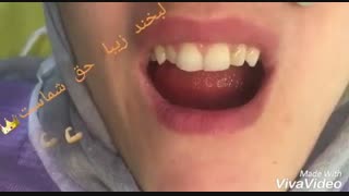 اصلاح طرح لبخند | دکتر حامد صالحی کاشت مو