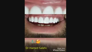 ۸ واحد کامپوزیت ونیر فک بالا | دکتر حامد صالحی