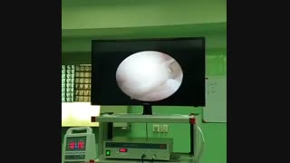 درمان بسته پارگی منیسک زانو