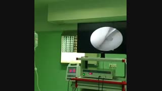 عمل درمان بسته پارگی منیسک زانو