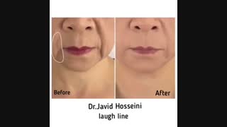 فرم دهی لب با ژل