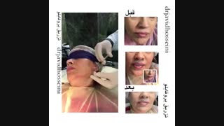 تزریق فیلر جهت جوانسازی صورت . درمان ریزش مو