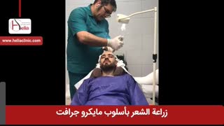 زراعة الشعر بطریقة مایکرو جرافت | عیادة هلیا | 00989120234708