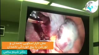 عمل لاپاراسکوپی و پیچ خوردگی تخمدان