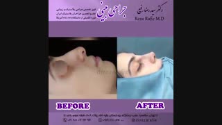 نمونه جراحی بینی | دکتر رضا رفیع
