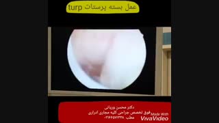 فیلم عمل جراحی بزرگی خوش خیم پروستات