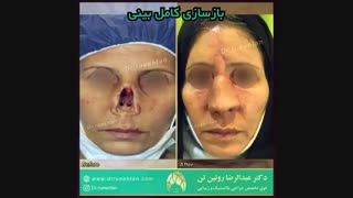 بازسازی بینی در بیمار مبتلا به سرطان پوست