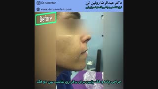 جراحی چانه و فک پایین
