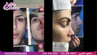 عمل زیبایی بینی