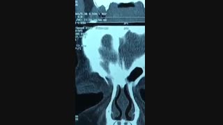 فیلم جراحی کیست درموئید