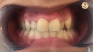 ارتودنسی کاموفلاژ بیماری با مشکل نامرتبی دندانی | دکتر فرهاد گرجی