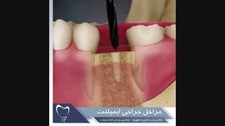 مراحل جراحی ایمپلنت | دکتر زینب رضایی اسفهرود لیپوماتیک