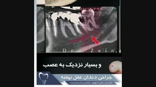 جراحی دندان عقل نهفته | دکتر زینب رضایی اسفهرود پروتز دندان